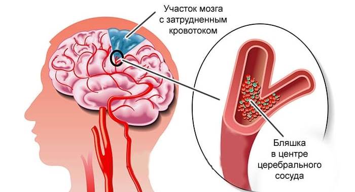 Атеросклероз сосудов
