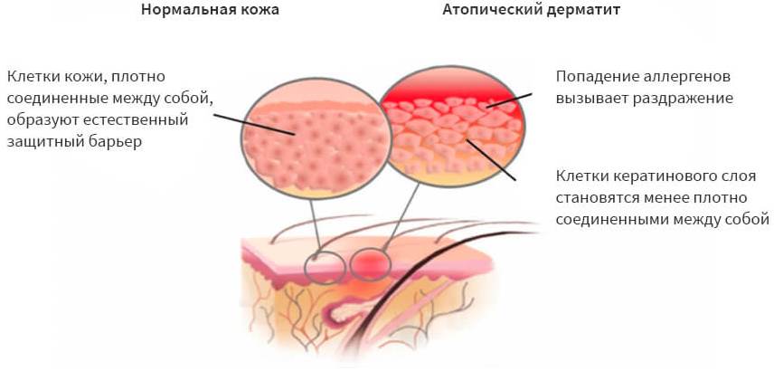 Атопический дерматит
