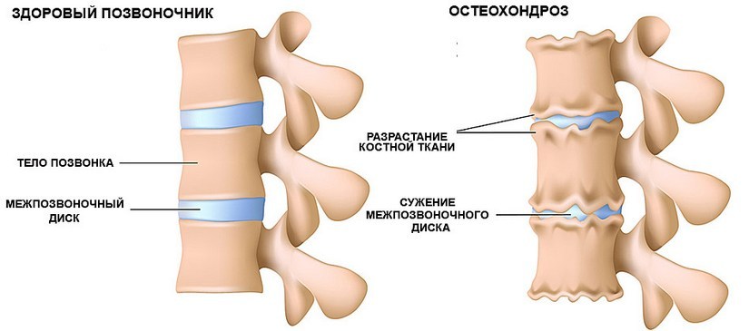 Как выглядит остеохондроз позвоночника