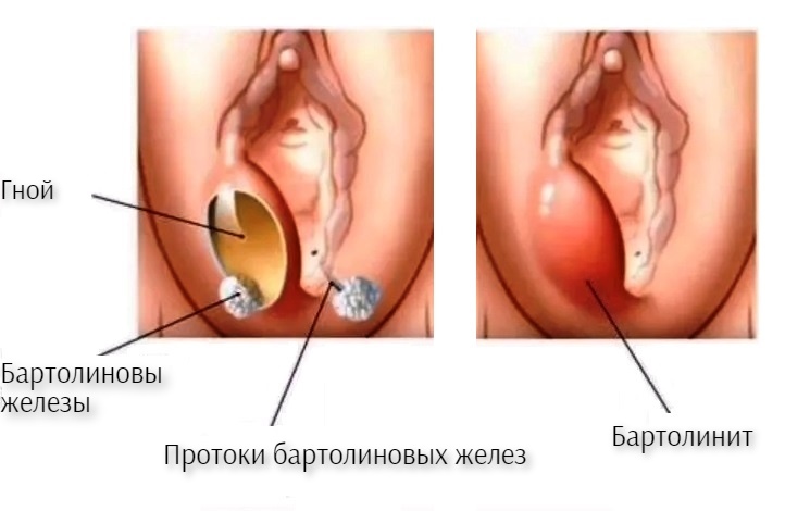 Признаки Бартолинита