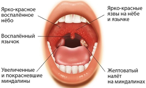 Признаки фарингита