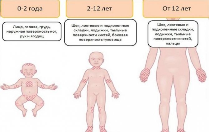 Проявление нейродермита у взрослых и детей