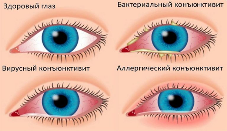 Разновидности конъюнктивита