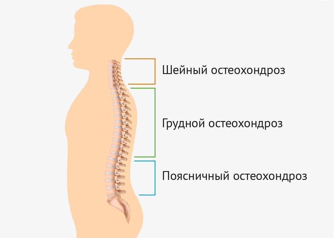 Виды остеохондроза позвоночника