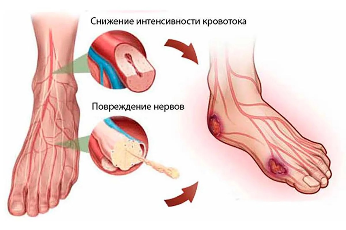Симптомы диабетической ангиопатии