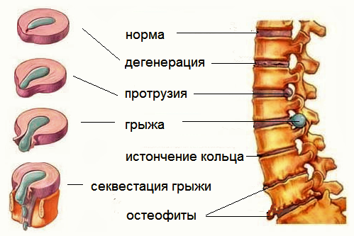 Стадии развития остеохондроза позвоночника
