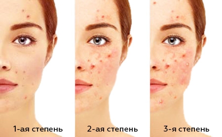 Степени развития акне