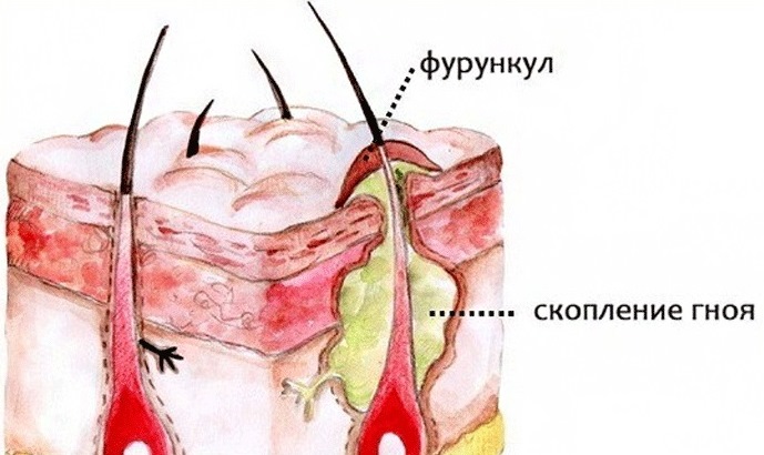 Строение фурункул