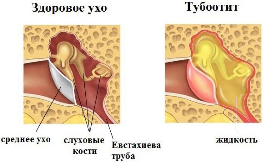 Ухо с острым тубоотитом и без