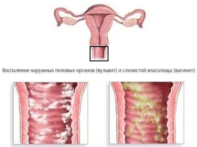 Вульвит